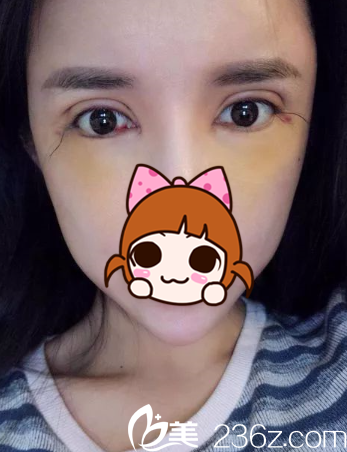 术后第二天,眼睛有点生硬 术后第二天,眼睛有点生硬