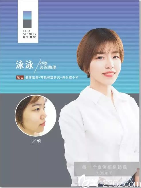 宁波和平博悦汪发生院长帮助25岁咨询助理做鼻综合手术成功摆脱塌肥宽形象