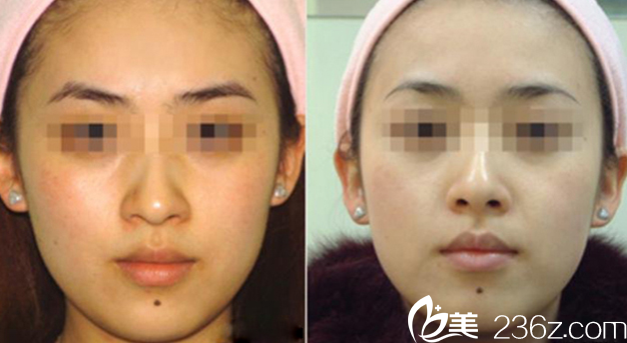 广州星团医美胡广孙光子嫩肤案例