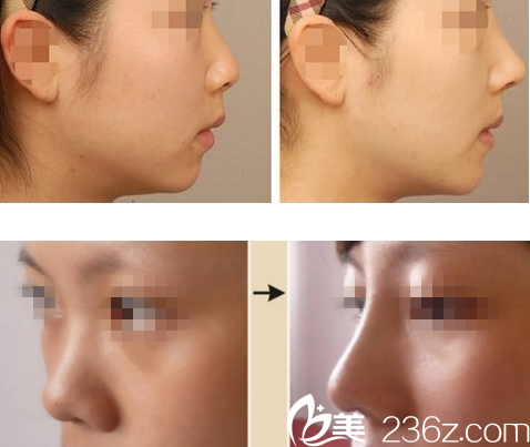 重庆赛格尔整形隆鼻<span style=