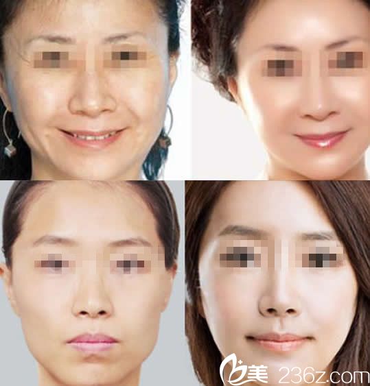 华美整形全面除皱效果