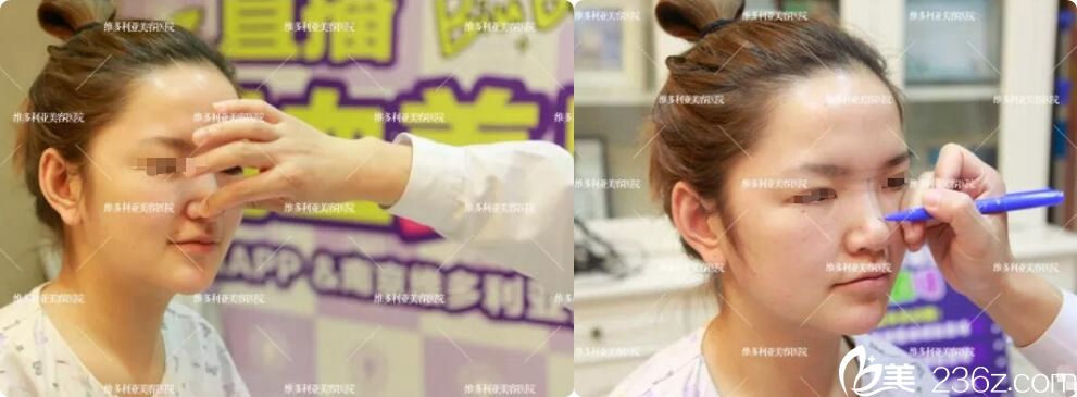 隆鼻之前的面诊过程