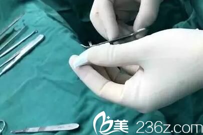 射极峰隆鼻手术过程