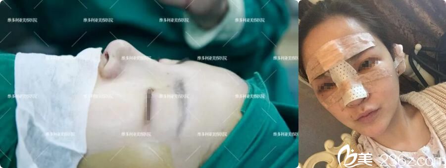 南京维多利亚隆鼻术后即刻效果