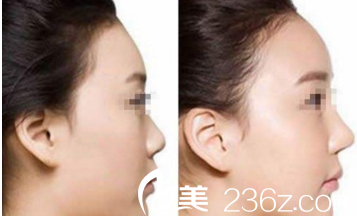 隆鼻案例重庆赛格尔整形马强 隆鼻案例重庆赛格尔整形马强