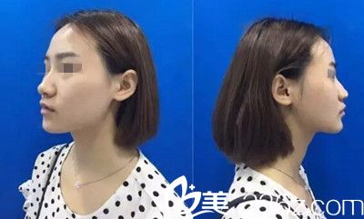 在南阳美莱做鼻综合手术前 在南阳美莱做鼻综合手术前