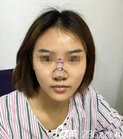 在南阳美莱做鼻综合手术前设计 在南阳美莱做鼻综合手术前设计