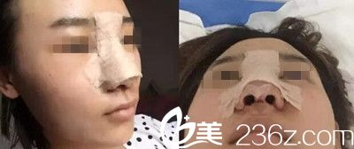 在南阳美莱做鼻综合手术后一天 在南阳美莱做鼻综合手术后一天