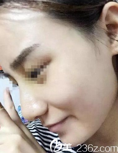 在南阳美莱做鼻综合手术后6天 在南阳美莱做鼻综合手术后6天
