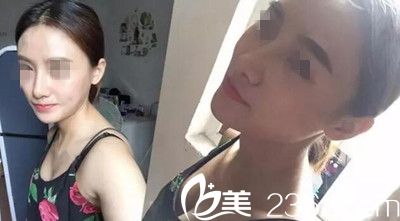 在南阳美莱做鼻综合手术后12天 在南阳美莱做鼻综合手术后12天