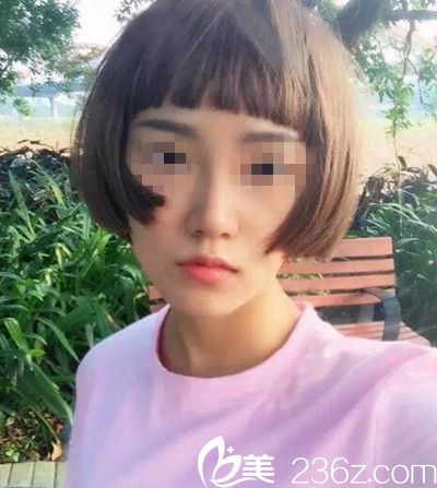 记录我在南阳艾美花32800元做鼻综合手术后恢复2个月的全过程