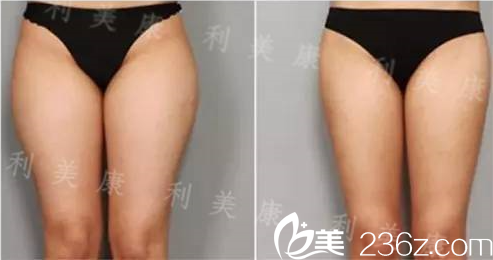 席主任做大腿吸脂术后对比 席主任做大腿吸脂术后对比