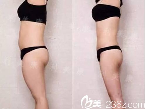 席小红做腰腹部及大腿吸脂术后效果 席小红做腰腹部及大腿吸脂术后效果