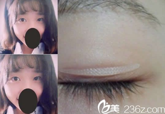 呼和浩特华整形割双眼皮前 呼和浩特华整形割双眼皮前