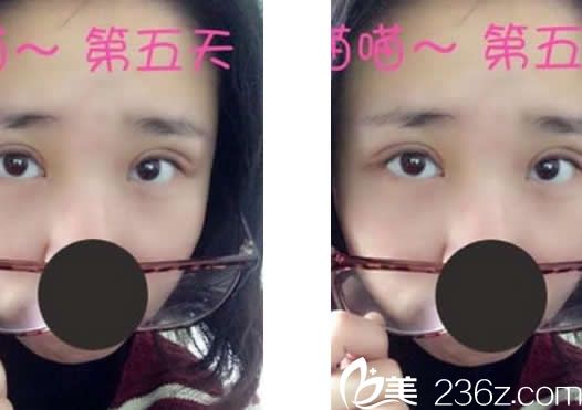 华美<!--<i data=20240703-sp></i>-->定点双眼皮第五天效果 华美<!--<i data=20240703-sp></i>-->定点双眼皮第五天效果