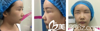 重庆赛格尔马强假体隆鼻术前 重庆赛格尔马强假体隆鼻术前