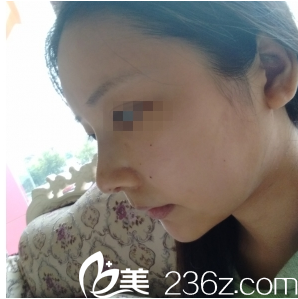 重庆赛格尔马强隆鼻7天拆线 重庆赛格尔马强隆鼻7天拆线