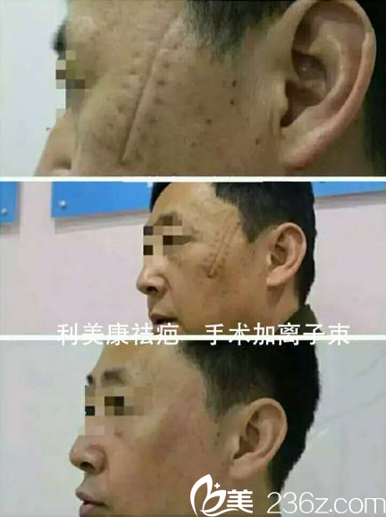 梁安裕祛疤案例 梁安裕祛疤案例