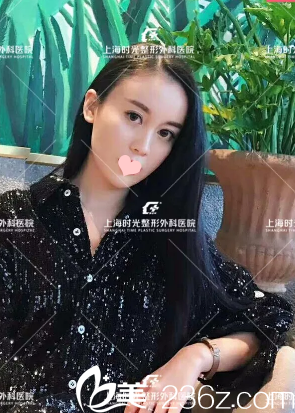 做完全脸脂肪填充一个月生活照