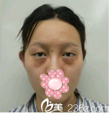 我做祛眼袋手术前 我做祛眼袋手术前
