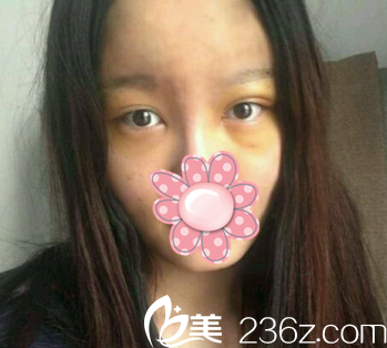 术后第5天 术后第5天