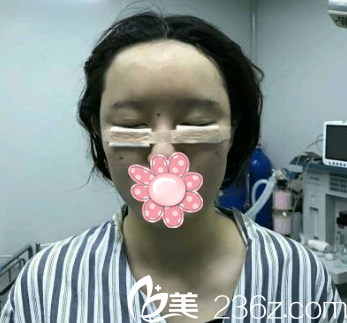 术后即刻 术后即刻