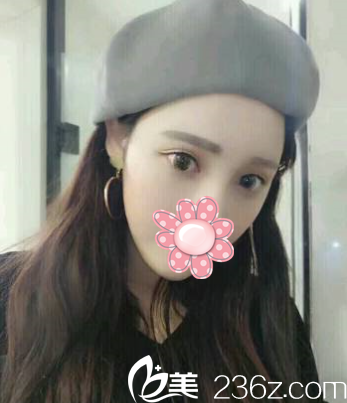 术后11天,看不到眼袋了 术后11天,看不到眼袋了