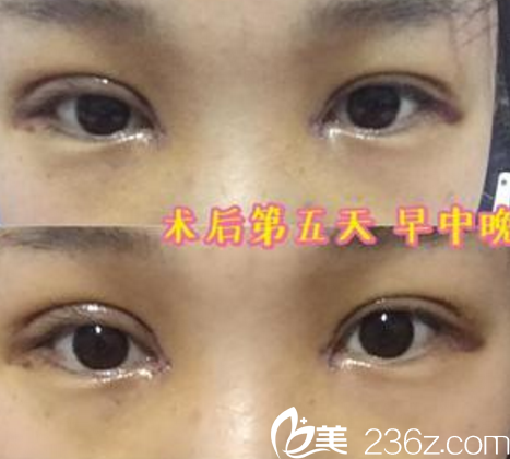 北京八大处甘承医生全切双眼皮第5天的细节图