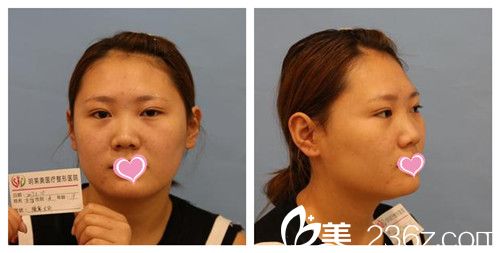 做隆鼻手术前鼻子塌平 做隆鼻手术前鼻子塌平