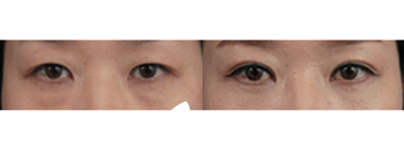 眼底脂肪再排至 眼底脂肪再排至