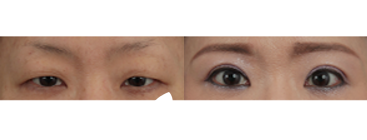 眼部案例之眼眉下拉术