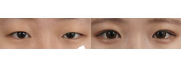 眼部手术案例之眼媚矫正 眼部手术案例之眼媚矫正