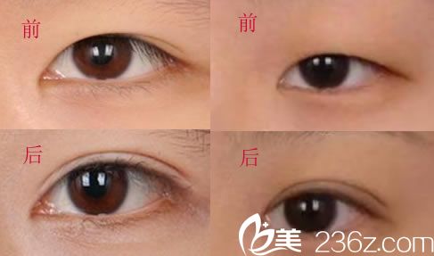 王春兰做双眼皮案例前后对比图