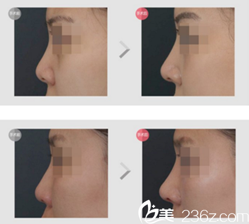 车明奎院长鼻修复案例 车明奎院长鼻修复案例