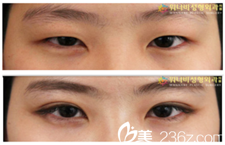 柳锡泰院长双眼皮真人案例对比