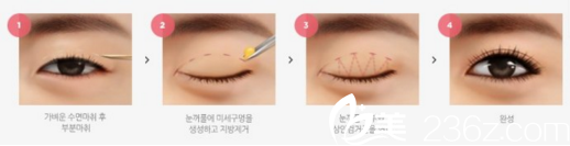 自然粘连法双眼皮手术过程