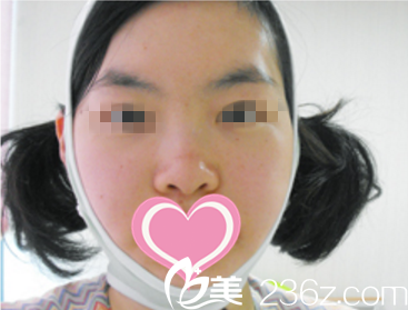 奥纳比整形术后第三天真人案例 奥纳比整形术后第三天真人案例