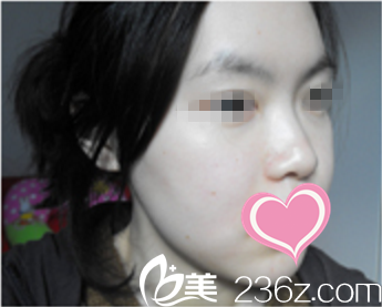 做完双颚手术后一周 做完双颚手术后一周