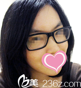 在奥纳比做完面部整形一个月后效果 在奥纳比做完面部整形一个月后效果