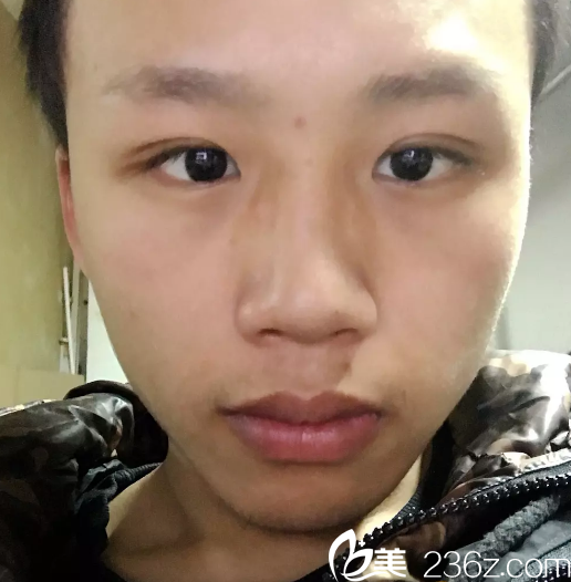 10月30日选了浙江省人民医院冀宇做全切双眼皮手术，晋升脱单男人