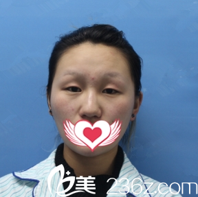 太原善美整形双眼皮案例术前 太原善美整形双眼皮案例术前