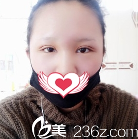太原善美整形双眼皮案例7天拆线 太原善美整形双眼皮案例7天拆线