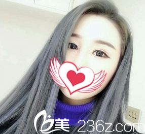 双眼皮案例术后2个月效果太原善美整形 双眼皮案例术后2个月效果太原善美整形