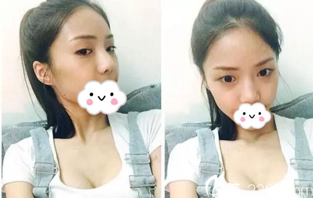 双眼皮+隆鼻术前样子 双眼皮+隆鼻术前样子