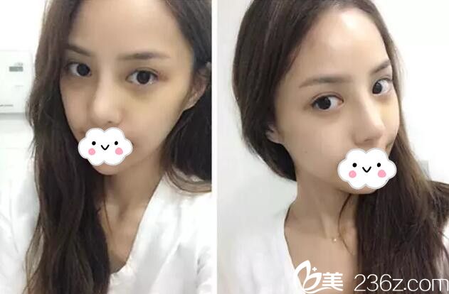 眼鼻整形术后15天恢复 眼鼻整形术后15天恢复