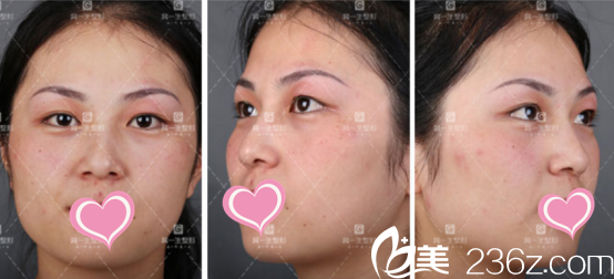 西安高一生切开双眼皮术前照 西安高一生切开双眼皮术前照