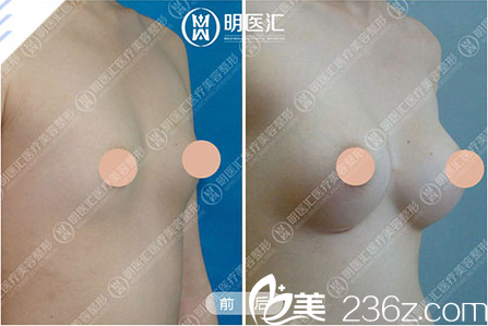 李耀宇胸部整形真人案例前后对比