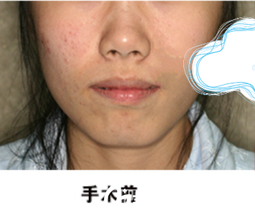 面部轮廓手术前 面部轮廓手术前