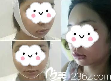 面部轮廓术后1周 面部轮廓术后1周