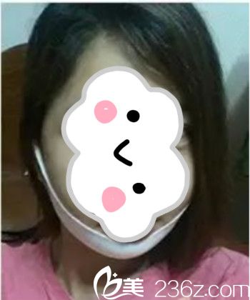 轮廓手术术后3周 轮廓手术术后3周